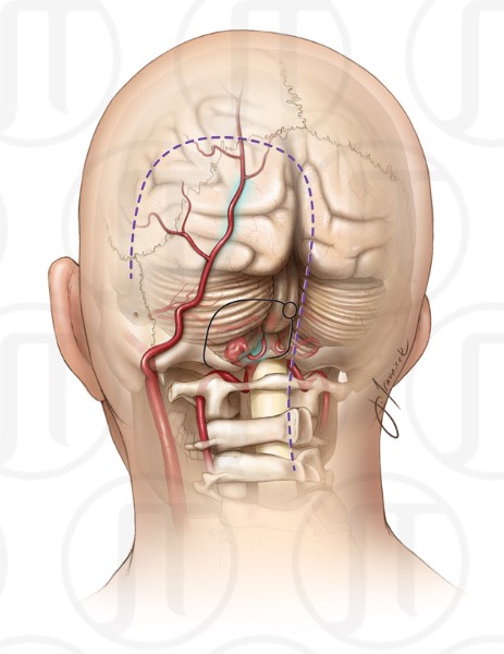 Occipital Artery Bypass