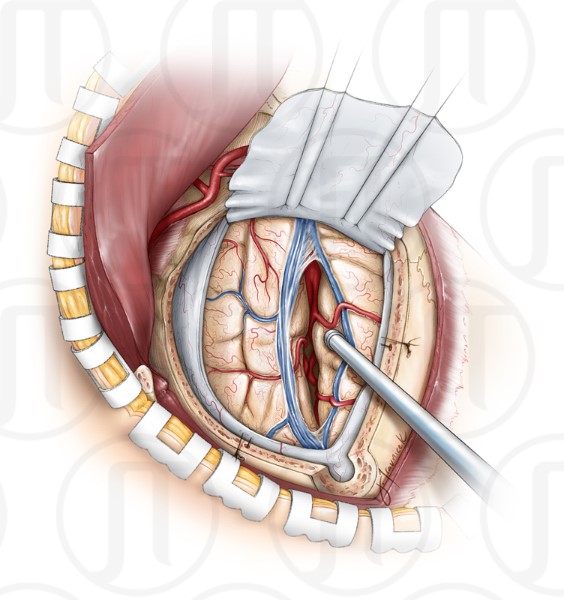 Internal Maxillary Artery Bypass