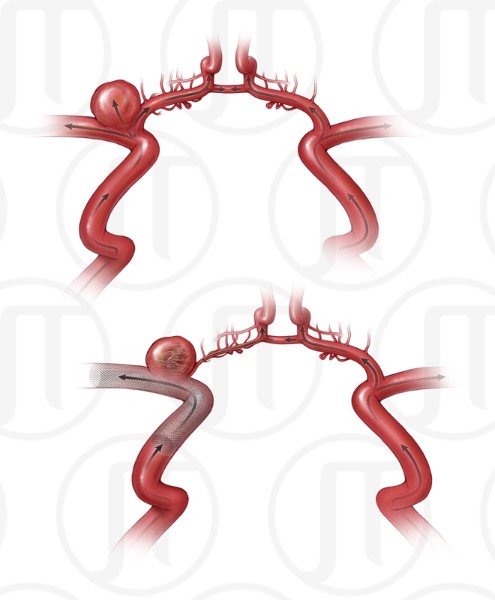 Internal Carotid Artery Flow Diverter